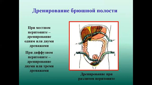 Острый перитонит кишечные свищи смотреть онлайн
