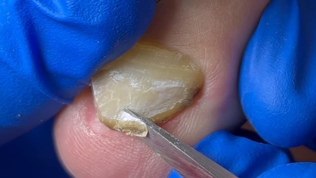 Accidentally injured toenails, removal of excess ingrown nails【Xue Yidao】 смотреть онлайн