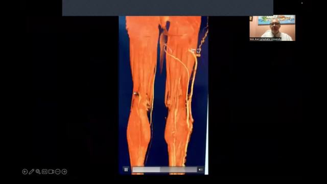 Vascular online training Fake venous news webinar of Egyptian venous forum , great webinar смотреть онлайн