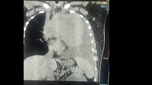 Диффузная В-клеточная лимфома переднего средостения смотреть онлайн