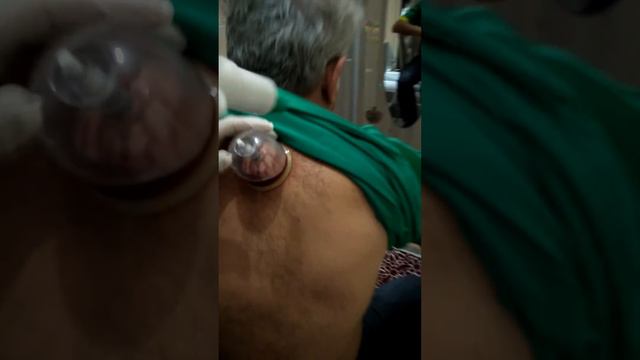 Нетрадиционная медицина в Турции (кровопускание) смотреть онлайн