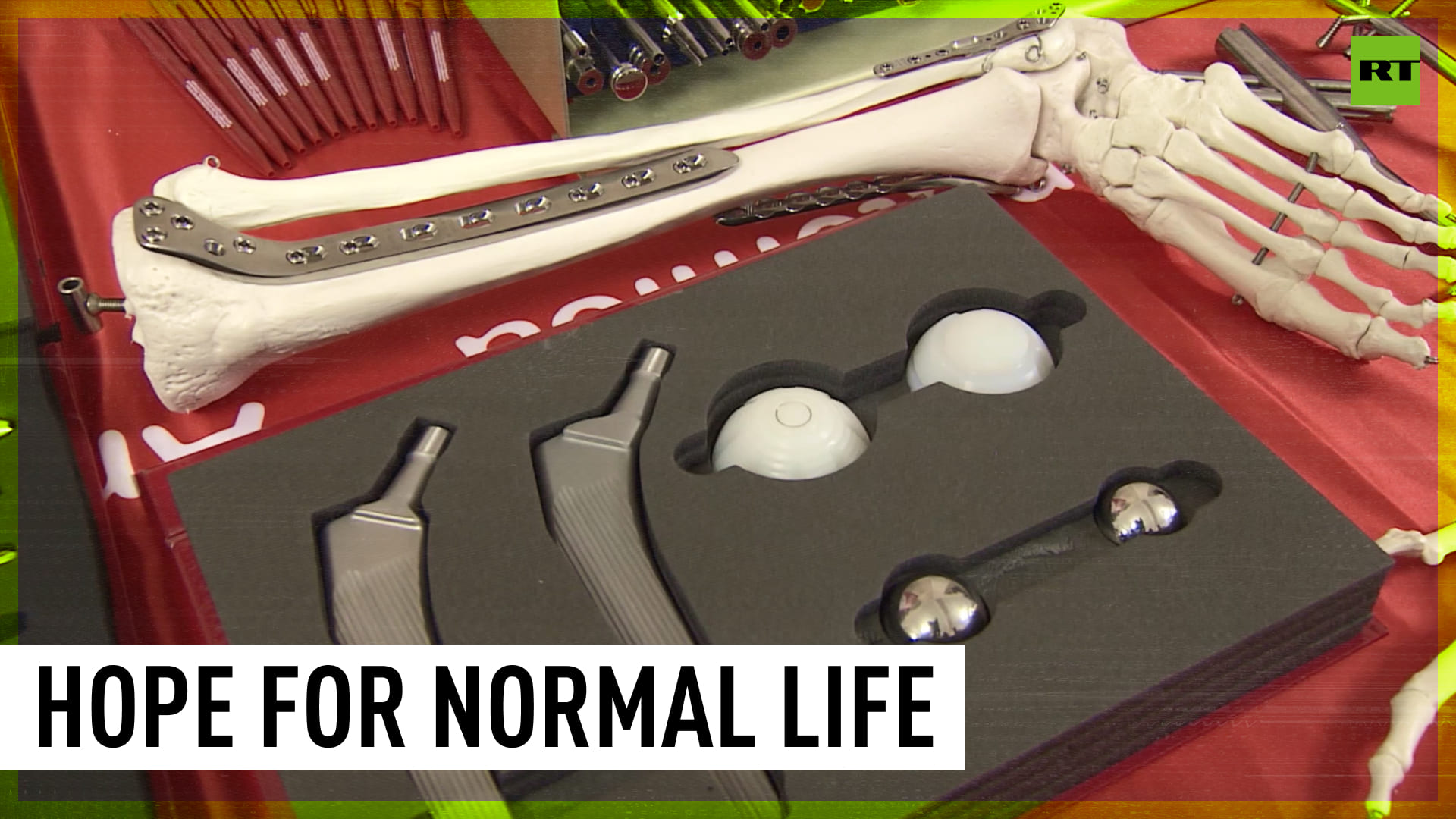 Russian Doctors Present New Limb Reconstruction Tech