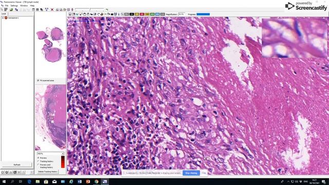 SWU Pathology: Talk Lab Hematopathology: Tuberculous lymphadenitis смотреть онлайн