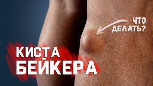 Киста Бейкера. Что делать если Вы нашли ее у себя?