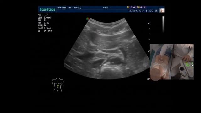 Ультразвуковая анатомия сосудов брюшной полости (демонстрация на пациенте) смотреть онлайн