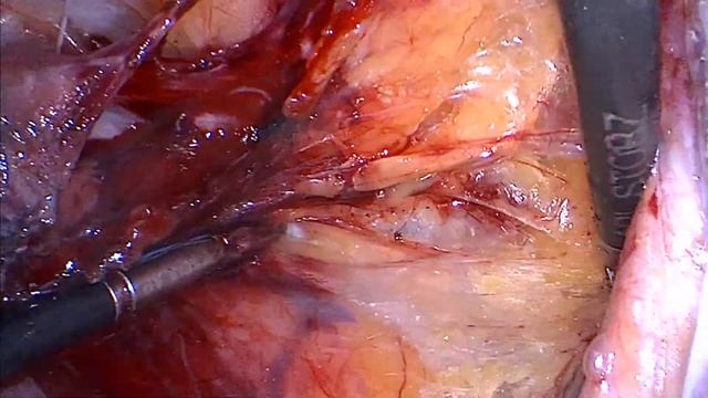 Sentinel Lymph Node in endometrial cancer with blue dye - Prof. Dr. Bratila Elvira смотреть онлайн