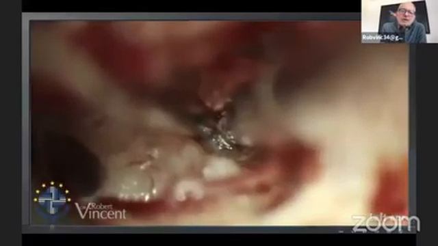 Learning from failure in ear surgeries | ENT | Dr Robert vincent and Dr meenesh juvecar смотреть онлайн