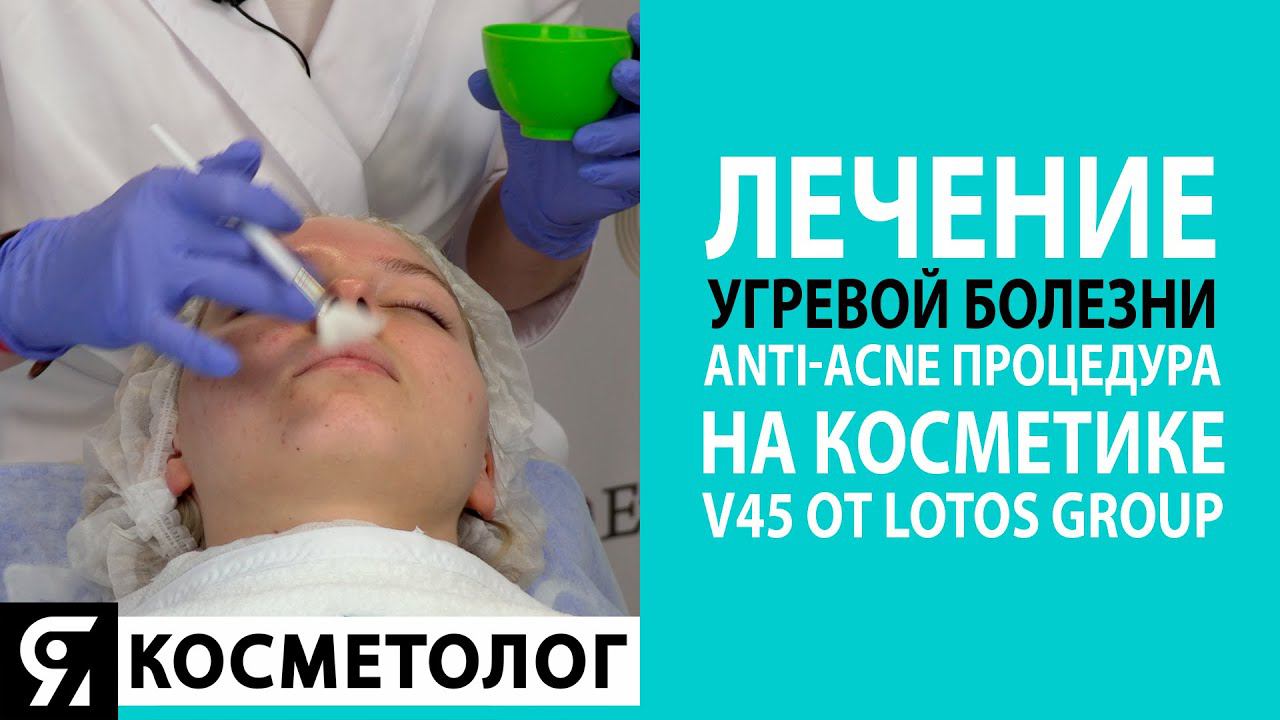 Лечение угревой болезни. Anti-acne процедура на косметике V45 от Lotos Group. смотреть онлайн