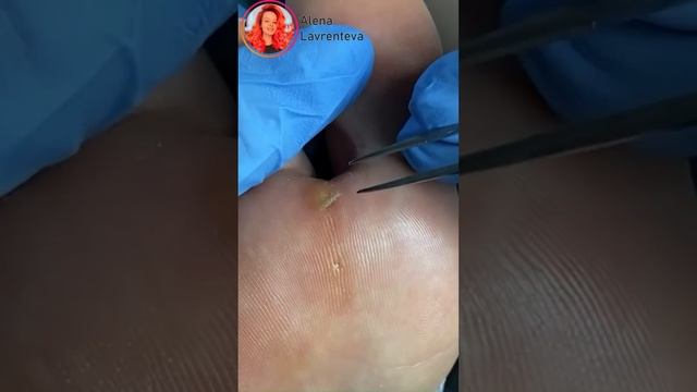 Как убрать стержневую мозоль? Вся стопа в стержневых мозолях! Так же есть полная версия на канале! смотреть онлайн