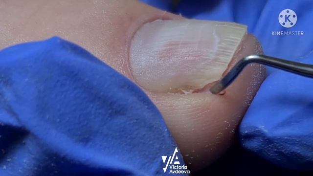 Педикюр. Подногтевая мозоль. Кюретка и рашпиль смотреть онлайн