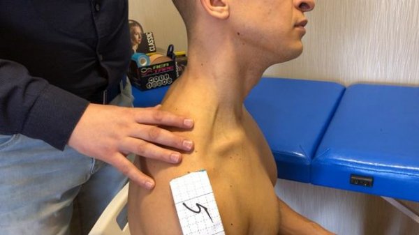 Наложенте кинезио тейпа на верхнюю порцию трапеции.