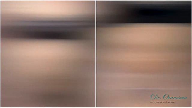 Липосакция. До и после. Пациент Н11.