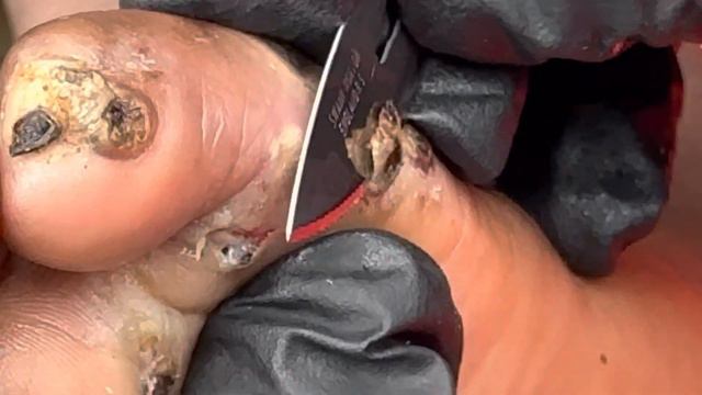 Jigger digging John Geza - big juicy jiggers were pulled out one by one, FULL VIDEO @.net смотреть онлайн