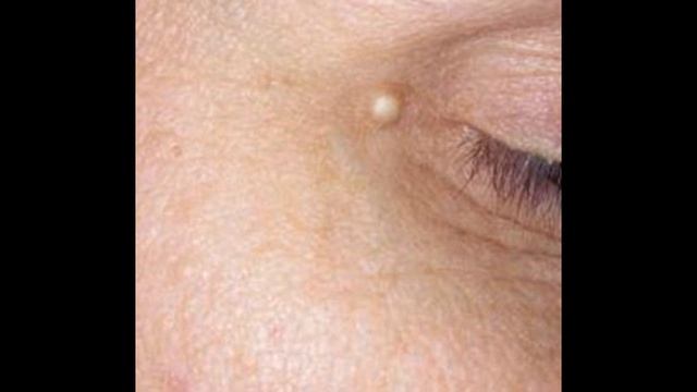 Жировик под глазом смотреть онлайн