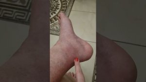 КРЕМ БЕЛОДЕРМ! ЭТОТ КРЕМ СПАС МОЮ НОЖКУ ОТ ТРОФИЧЕСКОЙ ЯЗВЫ! ДЕЛЮСЬ С ВАМИ СВОИМ ОПЫТОМ! ?