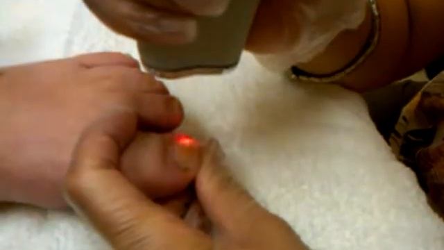 Sciton ClearToe Toe Nail Fungus Treatment смотреть онлайн