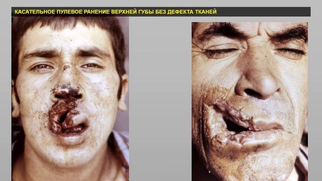 Огнестрельные ранения мягких тканей смотреть онлайн