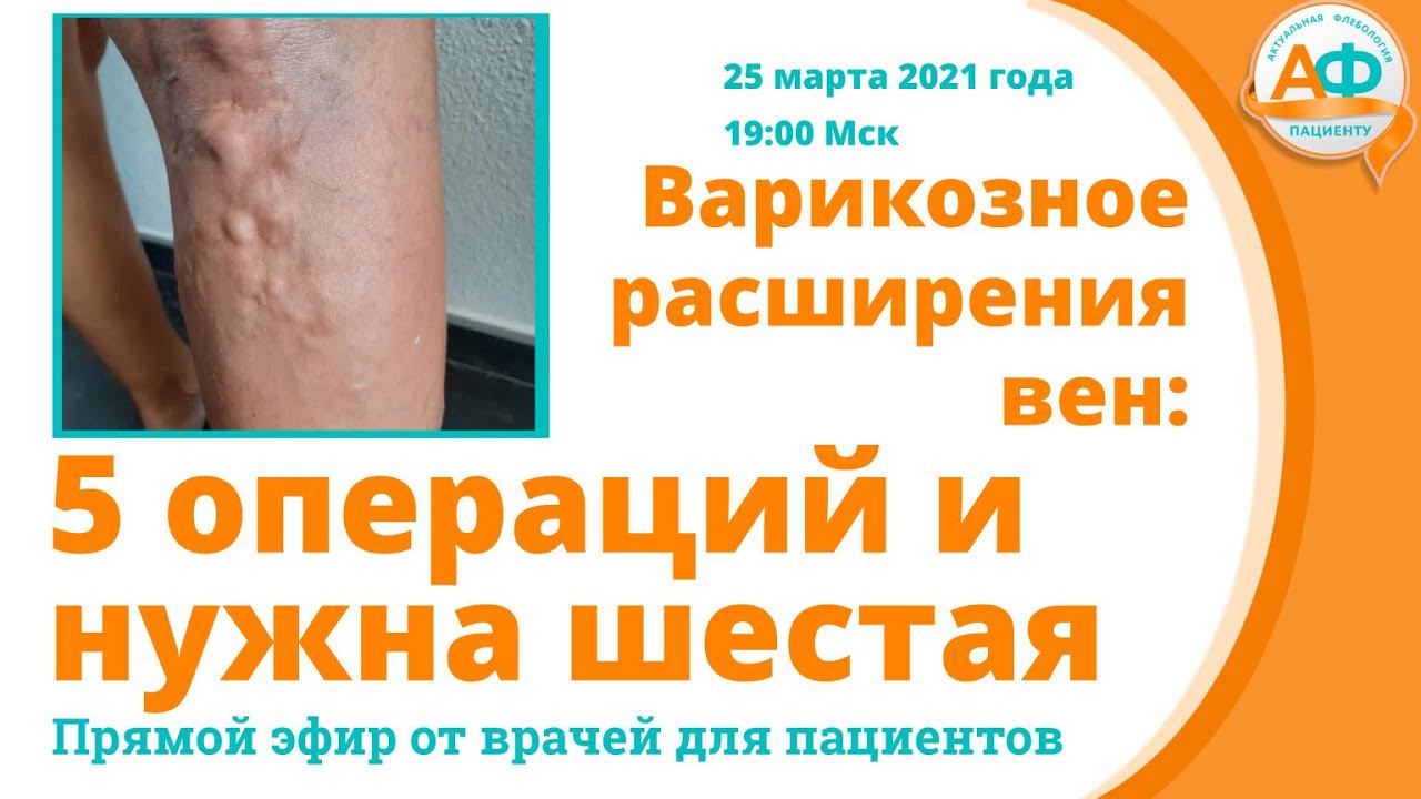 Варикозное расширения вен: 5 операций и нужна шестая смотреть онлайн