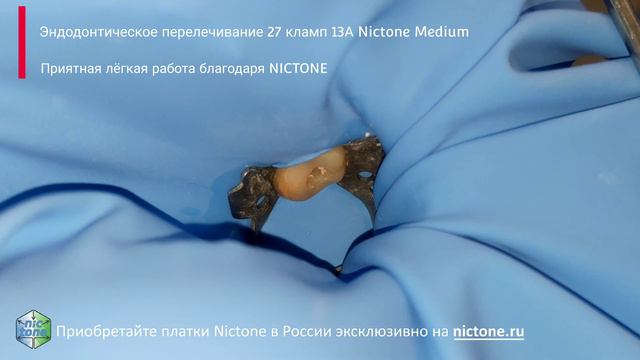 Изоляция 27 Nictone Medium временные коронки из акрила 26, 27 кламп 13А (4K) смотреть онлайн