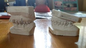 Клиническая функциональная проба Эшлера-Битнера в ортодонтии. Учебный видеофильм.