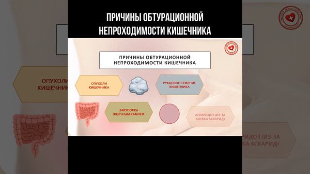 Причины обтурационной непроходимости кишечника #кишечник #болитживот #хирургия #живот смотреть онлайн