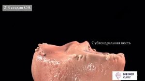 Этапы развития ОСТЕОАРТРОЗА коленного сустава