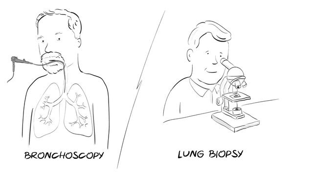 What is Idiopathic Pulmonary Fibrosis (IPF)? смотреть онлайн