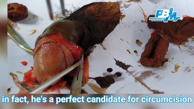 CIRCUMCISION OF A FAMILY MAN ( STAR FRUIT STYLE )