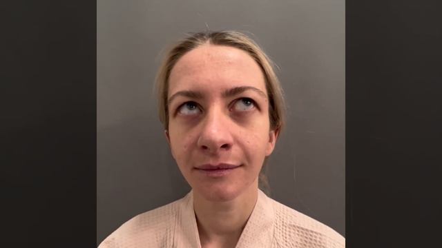 Верхняя блефаропластика