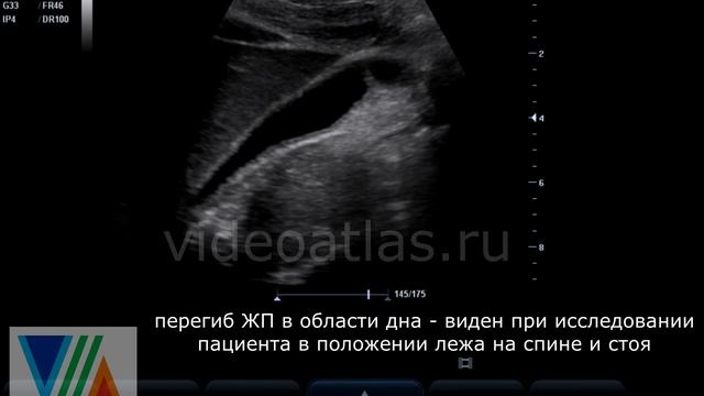 Аномальный перегиб ЖП по типу "фригийский колпак" смотреть онлайн