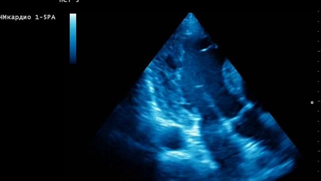 Noncompaction myocardium (NCM) - Некомпактный («губчатый») миокард (НКМ)или Губчатая кардиомиопатия смотреть онлайн