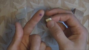 СТЕРЖНЕВАЯ МОЗОЛЬ как удалить в домашних условиях