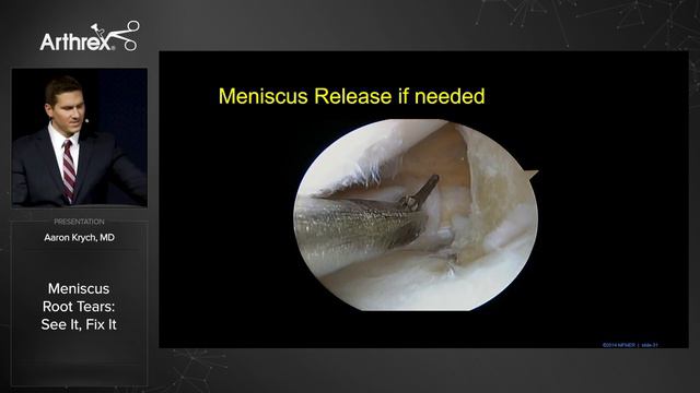 Meniscus Root Tears: See It, Fix It смотреть онлайн