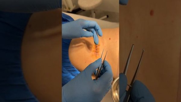 Обработка раны после хирургического удаления родинки. Онколог Джунковская Н.В., www.nevus.pro