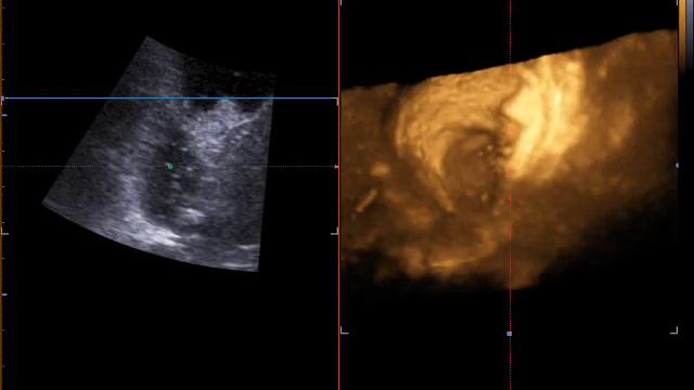 Ущемленный конркемент желчного пузыря 4D смотреть онлайн
