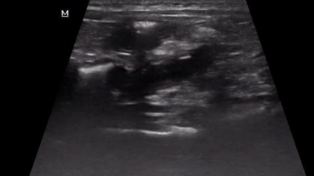 Энтерит. Динамическая кишечная непроходимость.