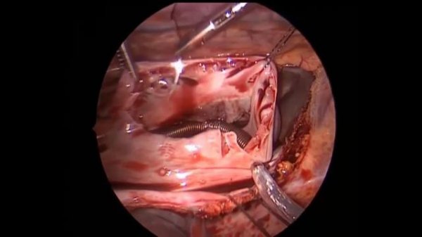 Торакоскопическая пластика ДМПП