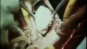 Дефект межпредсердной перегородки. Академик Б.В.Петровский © Atrial septal defect