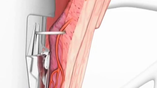 Проктология. Дезартеризация внутренних геморроидальных узлов. смотреть онлайн