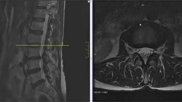 Lumbar Disc Herniation MRI Explained | Dr. Jeffrey P. Johnson | HD смотреть онлайн