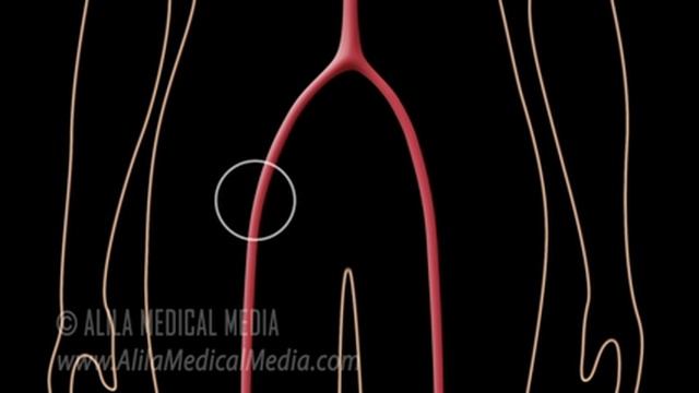 Myocardial Infarction and Coronary Angioplasty Treatment, Animation. смотреть онлайн