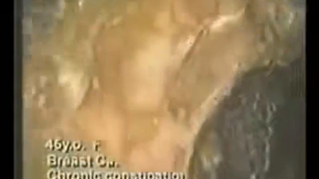 Очищение Кишечника в Домашних Условиях Очистка Организма от Шлаков и Токсинов травами, дегтем, угле смотреть онлайн