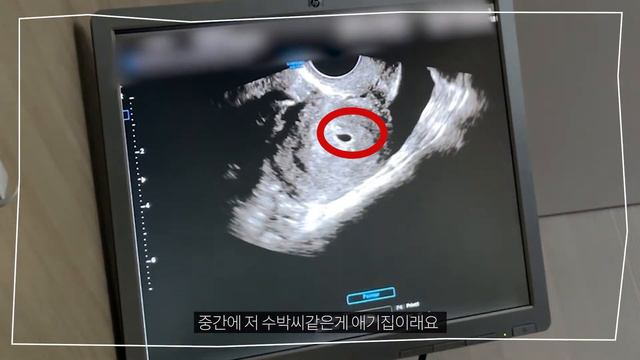 초이부부｜임신 4주5일 병원초음파 смотреть онлайн