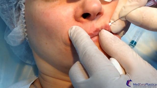 Коррекция верхней губы резорбтивным нитевым имплантом