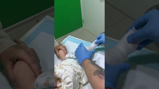 Гипсование по методу Понсети смотреть онлайн