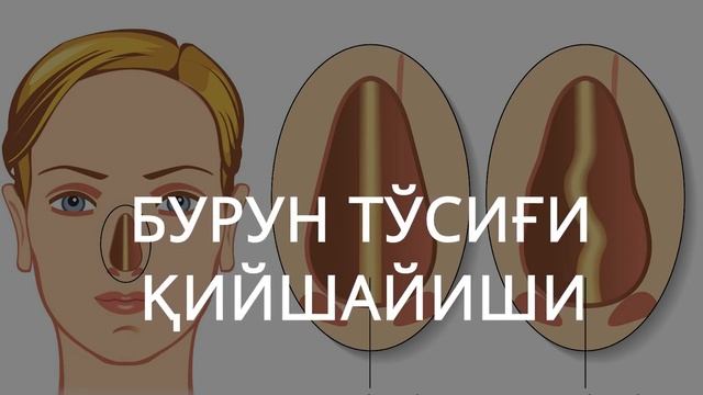 Болаларда тез тез бурун битиши давоси смотреть онлайн