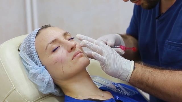 Гармонизация лица. Контурная пластика скул, губ, ботокс