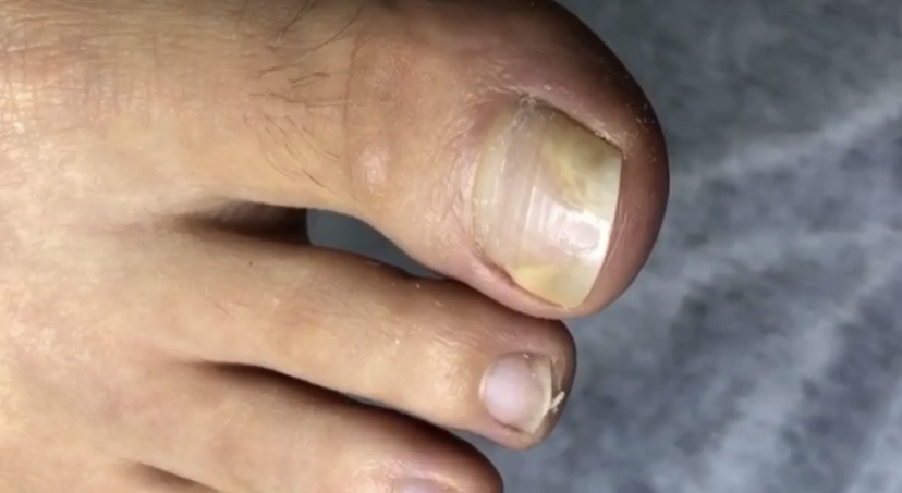 Онихолизис