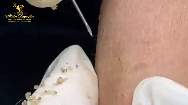 ? Выдавливание прыщей | Удаление и выдавливание прыщей и черных точек 2021 | Прыщи выдавливание #01 смотреть онлайн