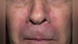 Себорейный дерматит что это?